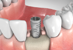 Implants